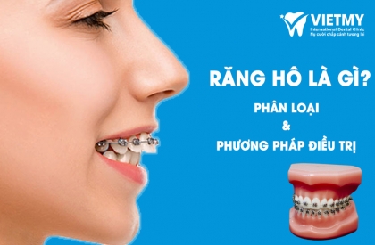 Răng Hô: Tình Trạng, Phân Loại, Và Phương Pháp Điều Trị